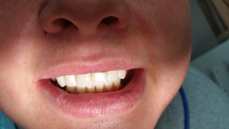 After-Licówki kompozytowe zębów górnych