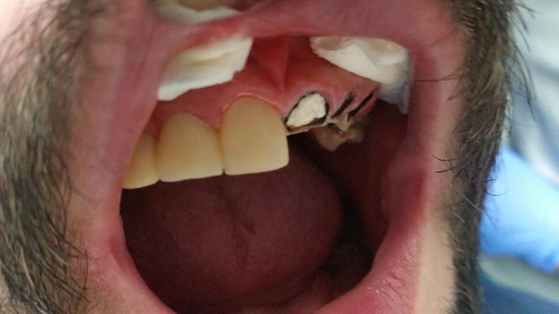 Before-Pacjent w trakcie leczenia estetyczna odbudowa zębów na wkładzie z włókna szklanego